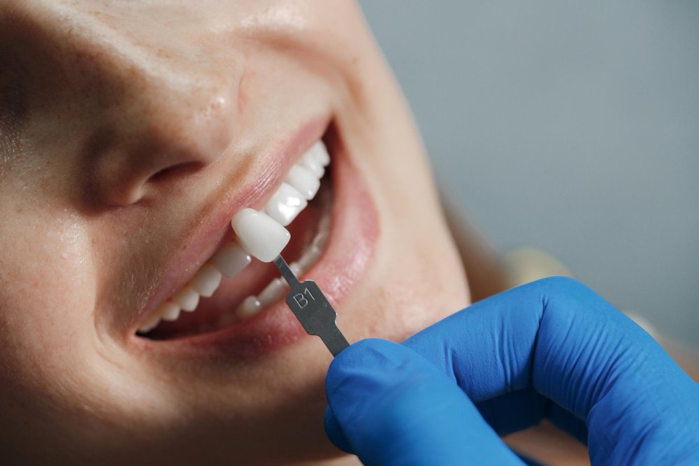 como recuperar seu sorriso com as opções de implantes dentários da IIROM